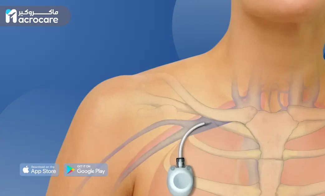 Port Cath Device: What Is It, Why Is It Used, and Macrocare’s Role in Safe Placement in Egypt cover image