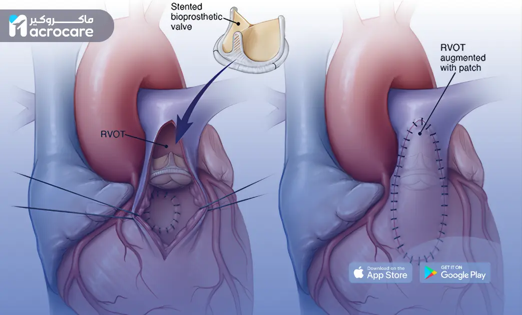 Pulmonary Valve Replacement: Advanced Heart Care and Medical Tourism with Macrocare cover image