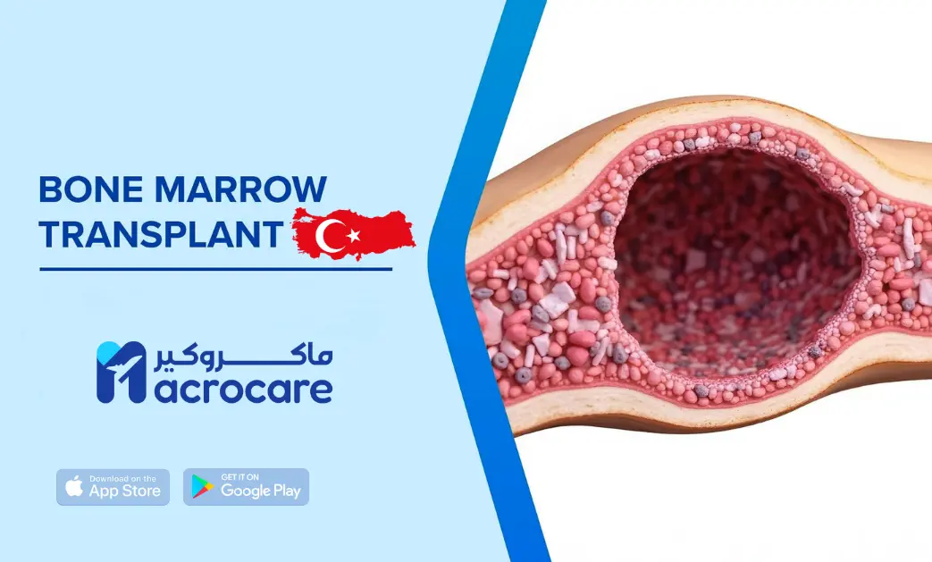Bone Marrow Transplant in Turkey: Everything You Need to Know with Macrocare Support cover image
