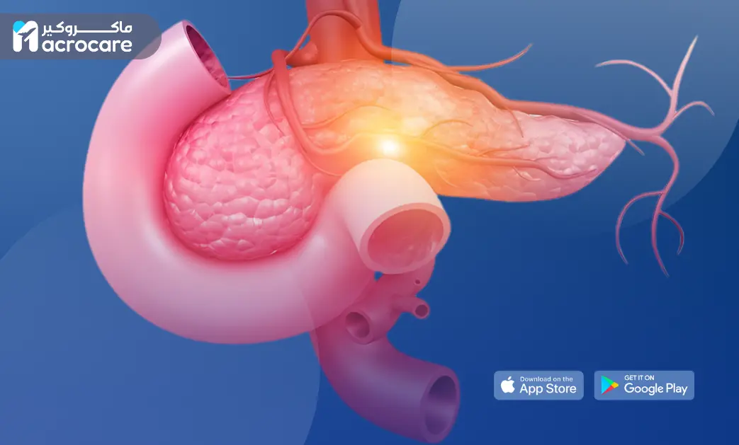 Pancreatic Cancer: Comprehensive Treatment and Medical Tourism in Egypt with Macrocare cover image