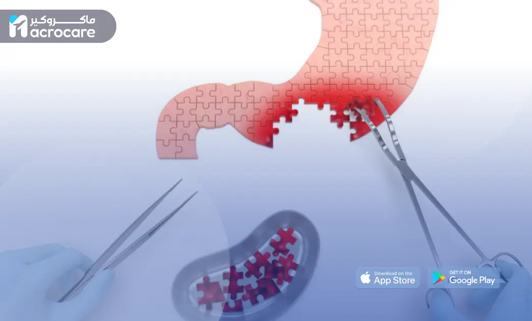 Kidney Removal Surgery in Egypt: A Comprehensive Guide to Safe Treatment and Medical Tourism with Macrocare cover image