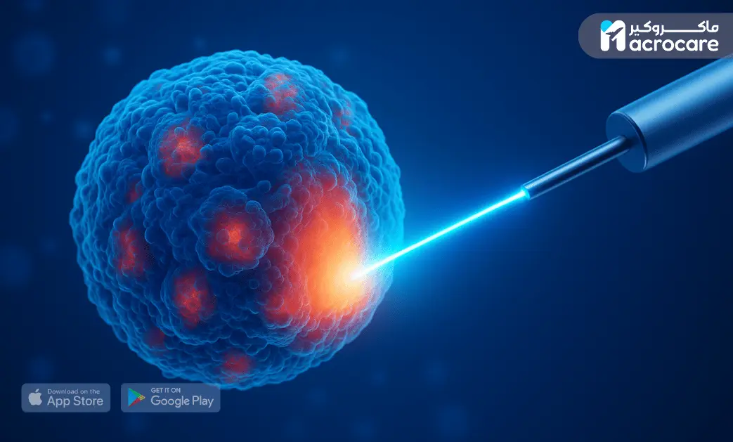 Microwave Ablation Therapy – A Modern, Minimally Invasive Cancer Treatment cover image