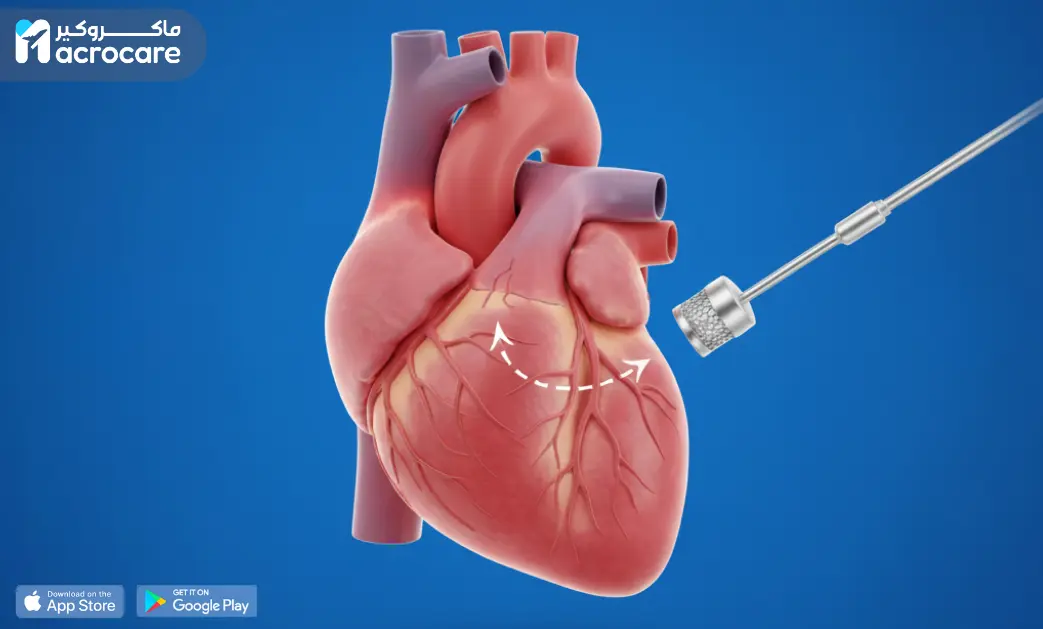 TAVI Surgery: The Modern Solution for Aortic Valve Stenosis Without Open-Heart Surgery cover image