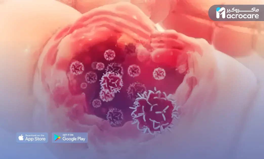What Is Macrocare’s Role in Sarcoma Treatment? cover image