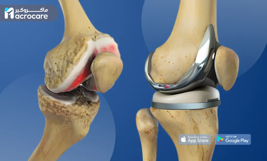 Knee Replacement Surgery: A Complete Guide to Regaining Mobility and Living Pain-Free cover image