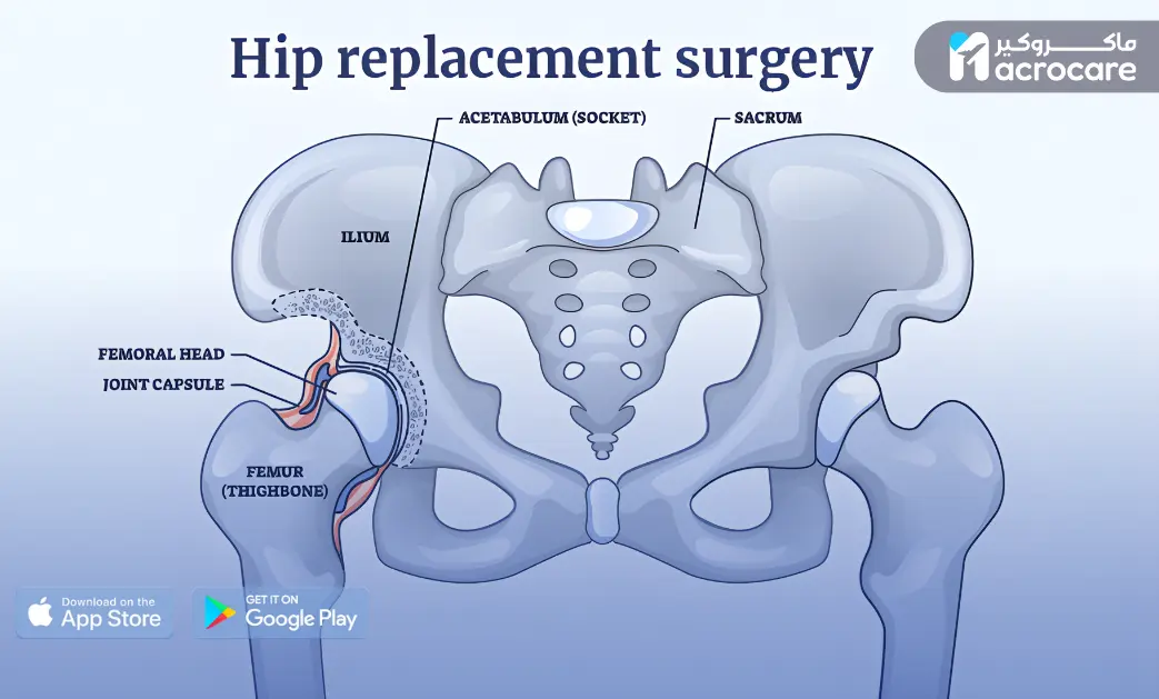 Hip Joint Replacement Surgery in Egypt cover image