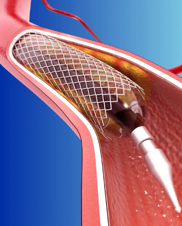 Balloon Angioplasty